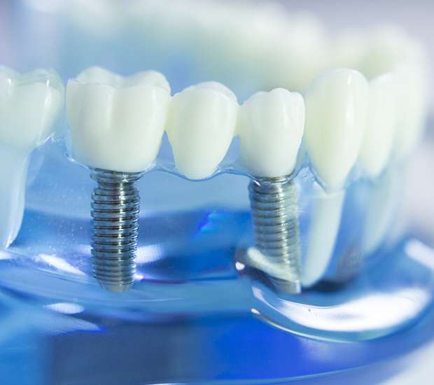 New York Dental Implants
