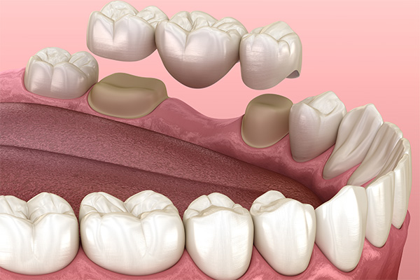 Options for Replacing Missing Teeth: An Overview of Dental Bridges from Comprehensive Dental Science, PC in New York, NY