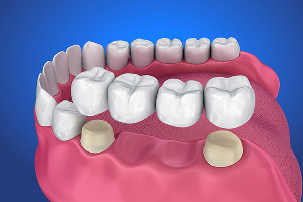 Options for Replacing Missing Teeth: The Benefits of Dental Implants from Comprehensive Dental Science, PC in New York, NY
