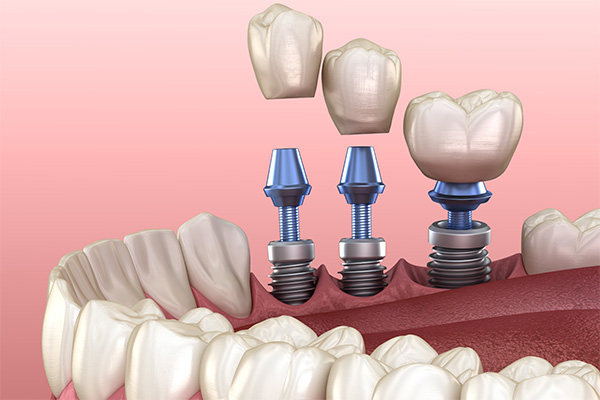 Reasons To Replace A Missing Tooth With Dental Implants