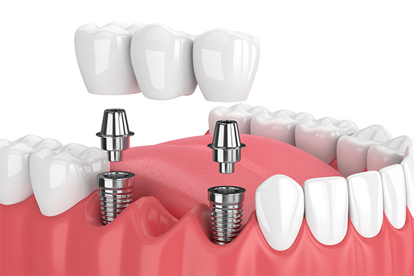 Options for Replacing Missing Teeth: Are Dental Bridges Right for Me? from Comprehensive Dental Science, PC in New York, NY