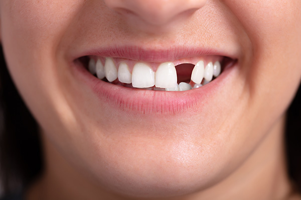 Options for Replacing Missing Teeth: What Procedures Are Recommended for Missing Front Teeth? from Comprehensive Dental Science, PC in New York, NY