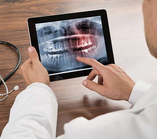 New York Types of Dental Root Fractures